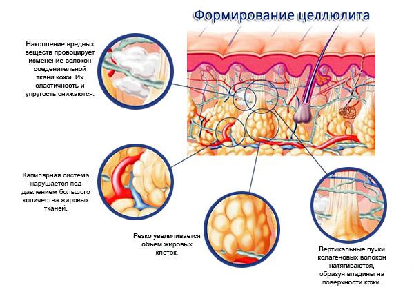 Борьба с целлюлитом в домашних условиях. Как избавиться от целлюлита в домашних условиях